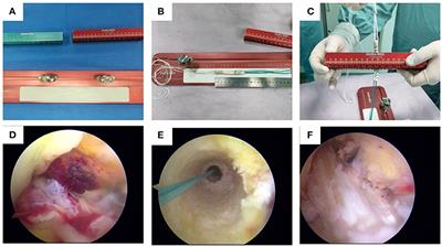 The safety and effectiveness comparison of Delta Medical's PEEK interface screw and Endobutton and that of Smith & Nephew's in arthroscopic anterior cruciate ligament reconstruction: A multicenter prospective double-blind randomized controlled clinical trial